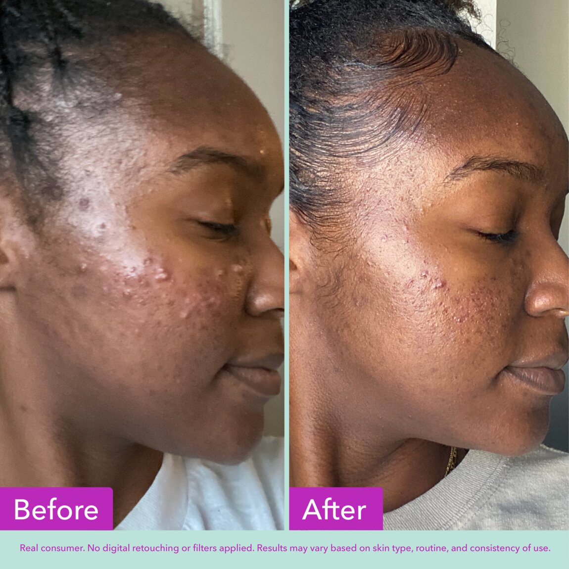 acne-foaming-cleanser-k2 zb_p.jpg